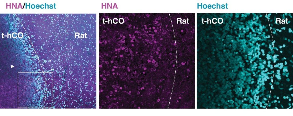 Gene-Based Therapy Restores Cellular Development and Function in Brain Cells From People With Timothy Syndrome