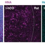 Gene-Based Therapy Restores Cellular Development and Function in Brain Cells From People With Timothy Syndrome